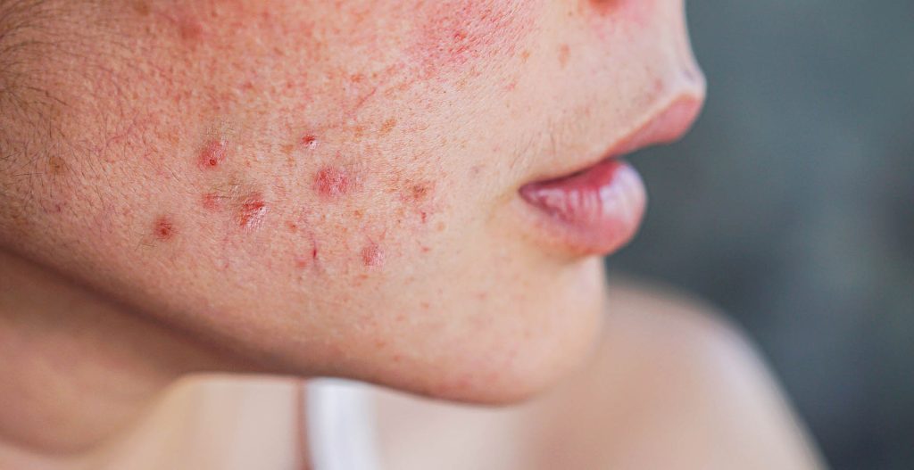 acne skin close up