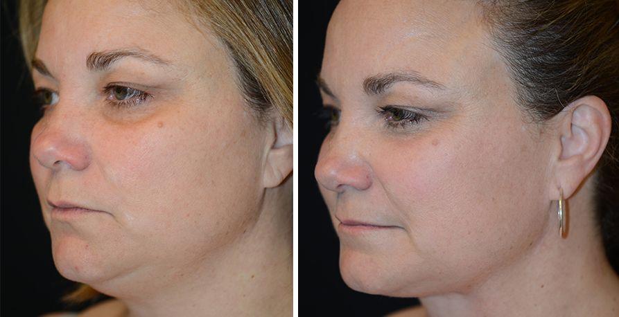 Smartlipo Results Golden State Dermatology