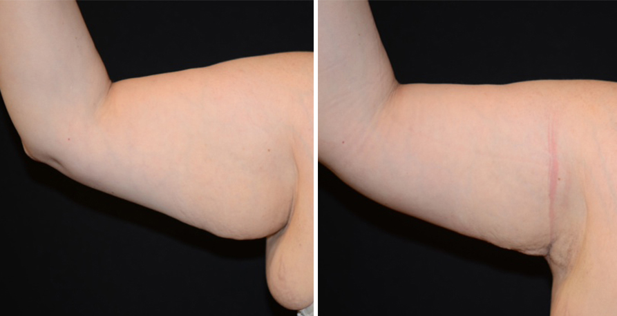 Smartlipo Results Golden State Dermatology