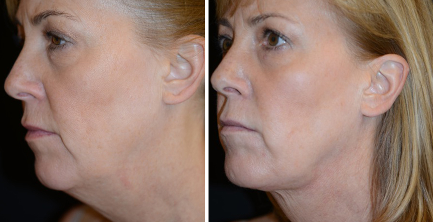 Smartlipo Results Golden State Dermatology
