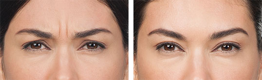 BOTOX Results