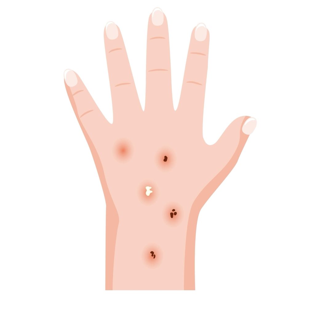 Illustration of a hand with several rough, scaly actinic keratosis lesions on the back and wrist.