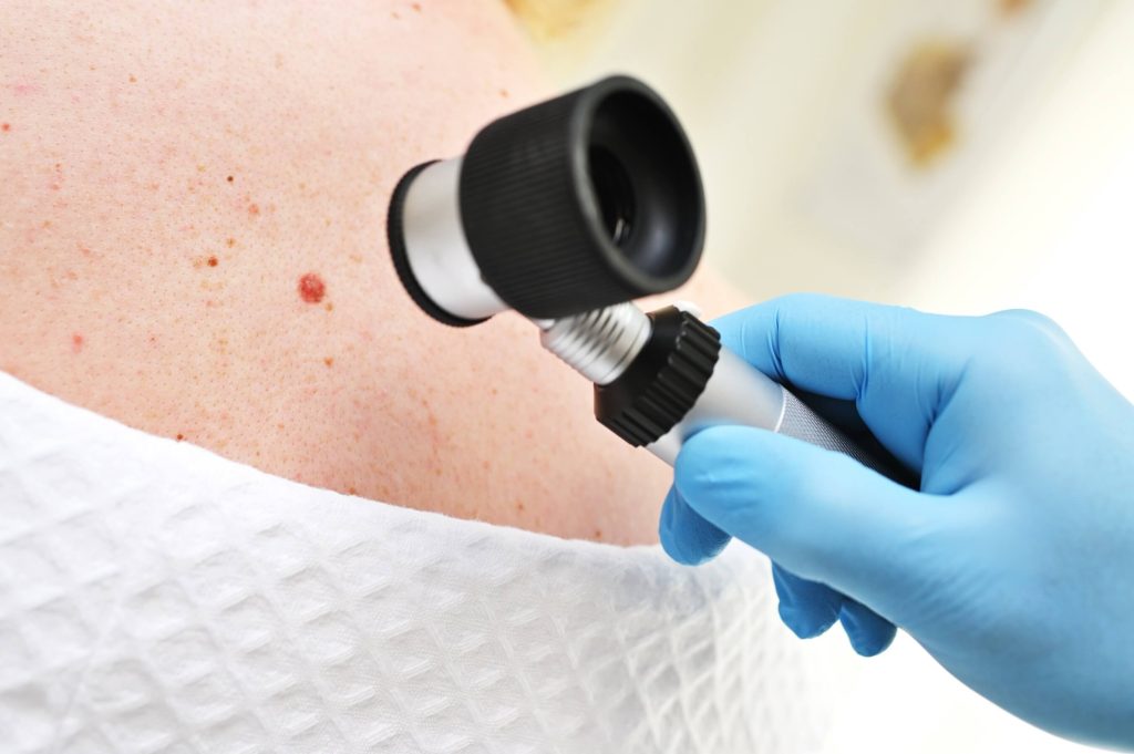 Dermatologist closely examining moles and other benign skin growths on a patient.
