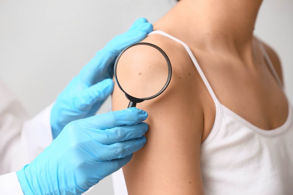 Dermatologist using a magnifying glass to examine moles on a young patient's skin.