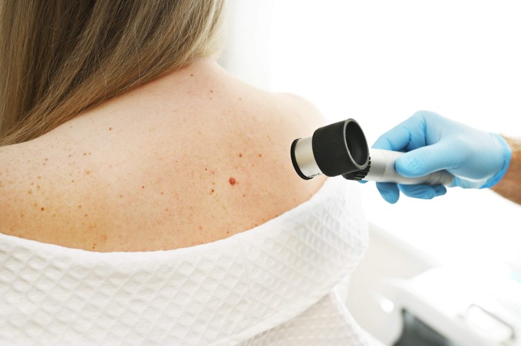 Dermatologist examining moles and skin growths closely during a skin cancer screening.