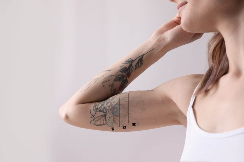 Before and after comparison of skin treated with laser tattoo removal.