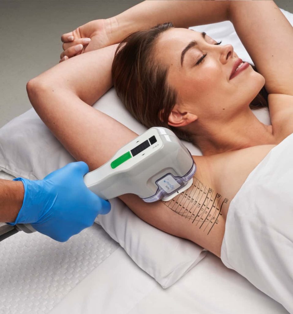 A miraDry handpiece being applied to a patient's underarm