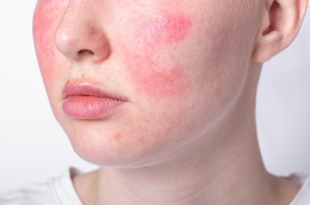 Close-up of facial skin showing rosacea — persistent redness and visible broken capillaries.