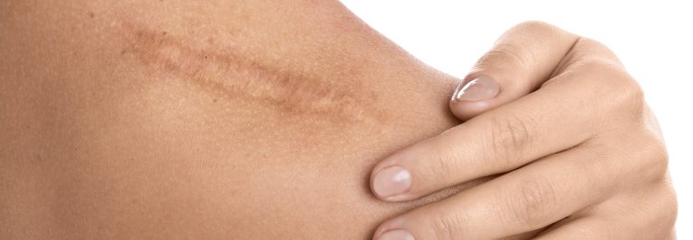 scar blog image